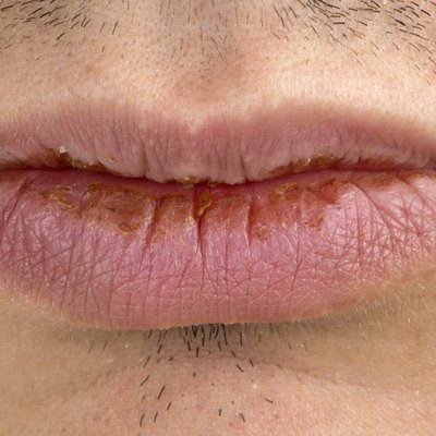 Manifestation of herpes