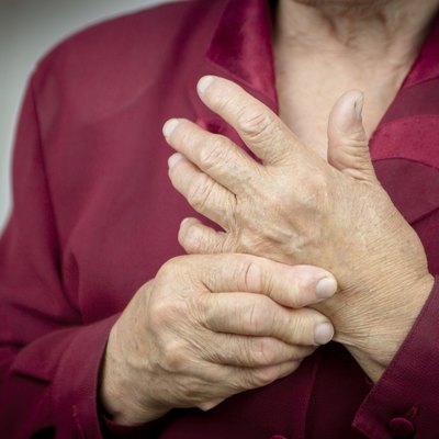 Rheumatoid arthritis hands