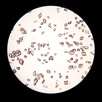 uric acid crystal in urine.