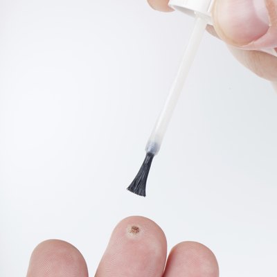 Treating a wart on finger