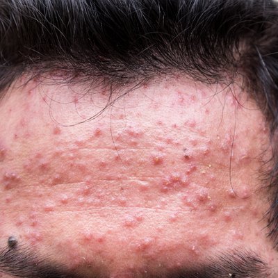 fore head of man having varicella blister or chickenpox