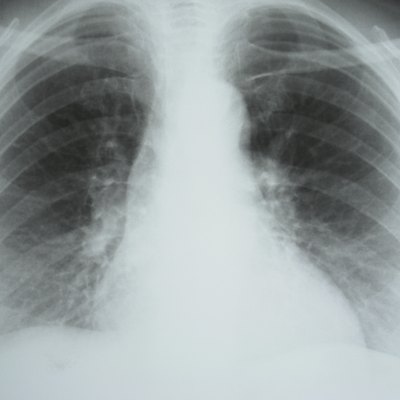 X-Ray