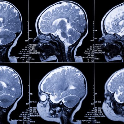 baby MRI Brain Scan:leukodystrophy illness and developmental anomaly