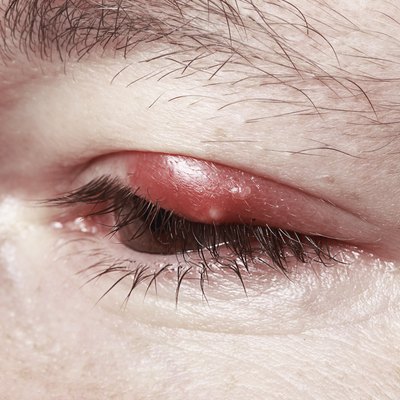 Sore Red Eye. Chalazion and Blepharitis. Inflammation