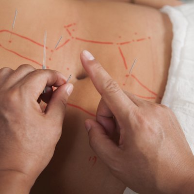 Inserting Acupuncture Needles