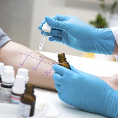 Skin prick allergy test