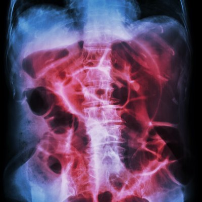 Bowel Obstruction