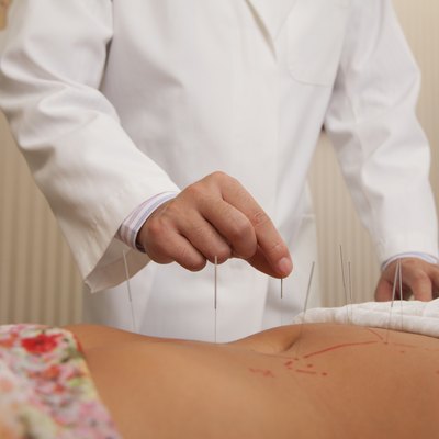 Inserting Acupuncture Needles