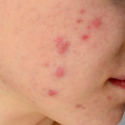 Human skin Acne
