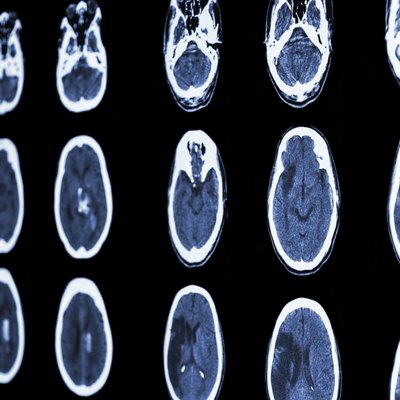 CT scan of brain show ischemic stroke and hemorrhagic strok