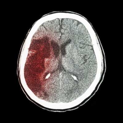 CT brain : show Ischemic stroke