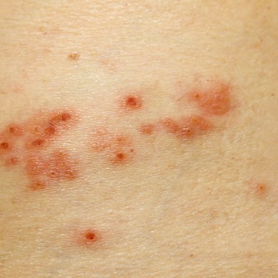 Shingles Rash