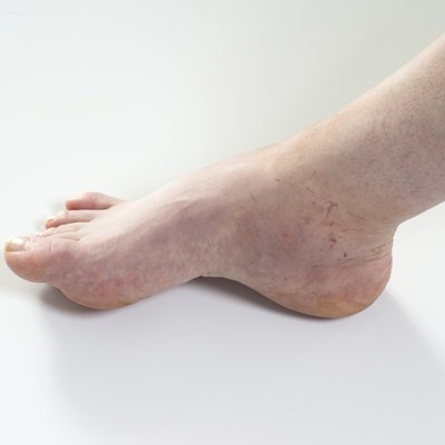 ankle sprain