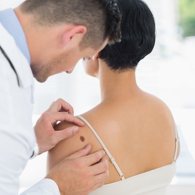 Doctor examining mole on back of woman