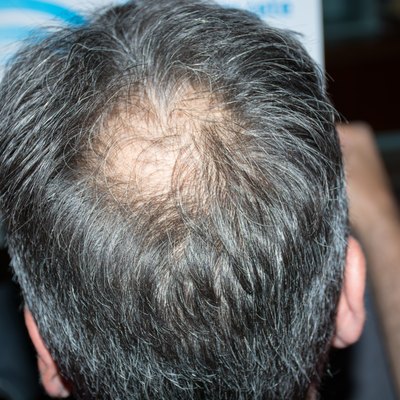 Mature man with balding.