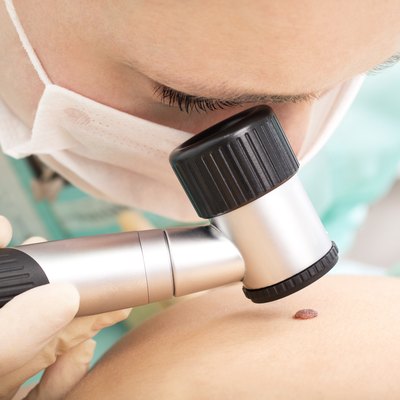 Dermatologist examines patient birthmark with dermatoscope