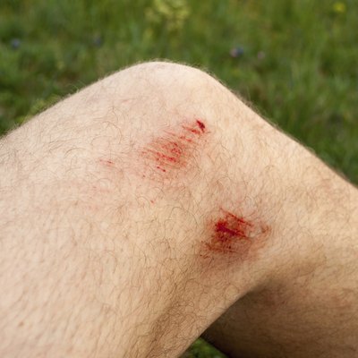 scratches on the knee