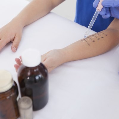 Doctor performing a skin prick test