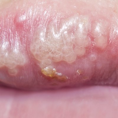manifestation of herpes