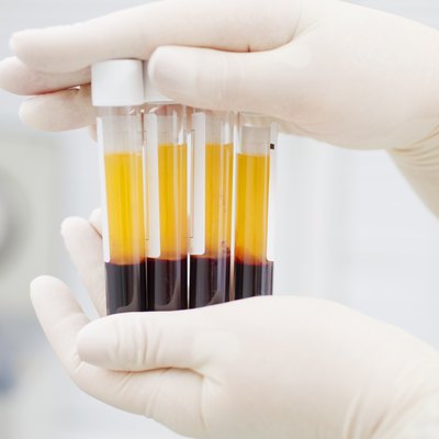 Preparing blood for Plasmolifting.