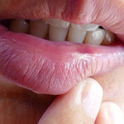 bruise at the lip