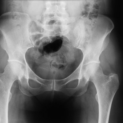 X-ray of human pelvis
