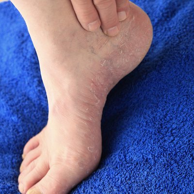Closeup of dry skin on foot