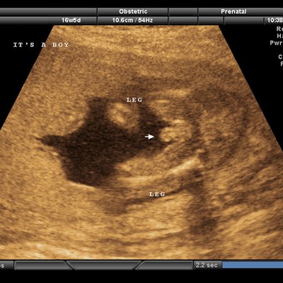 Ultra sound scan of fetus