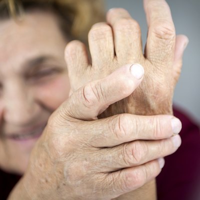 Hands Of Woman Deformed From Rheumatoid Arthritis