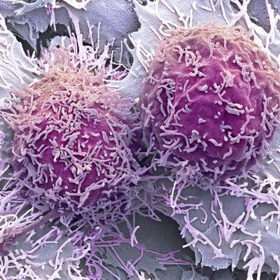 Liver cancer cells, SEM