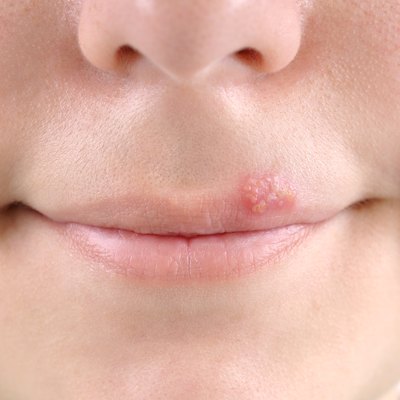 Herpes