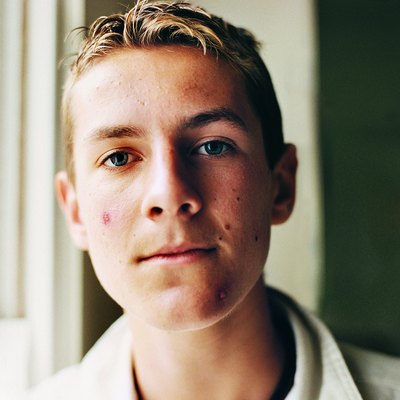 Portrait of a Male Teenager With Acne