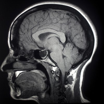 MRI Sagittal Brain