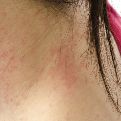eczema skin on neck