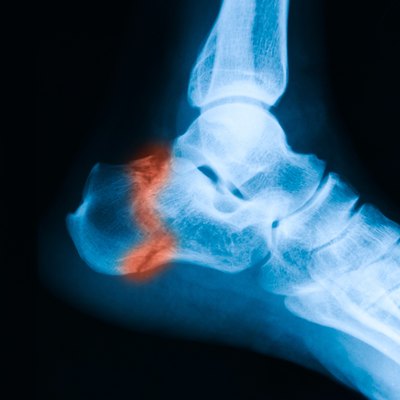 X-ray image of ankle, lateral view.