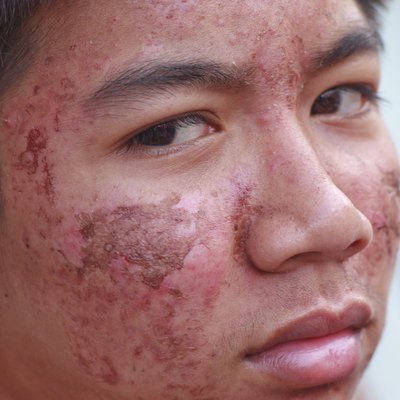 Male ace with acne problem skin