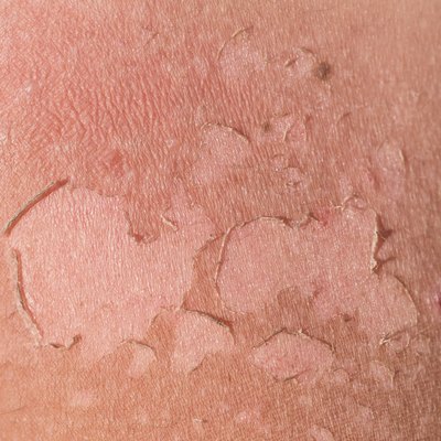 Sunburn