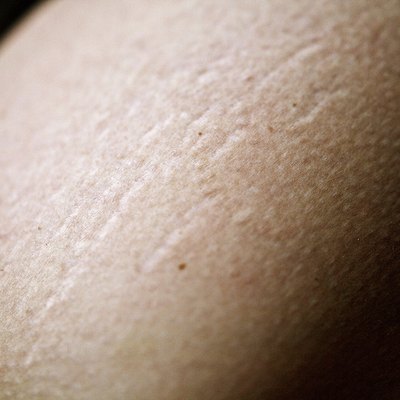 Stretch Marks
