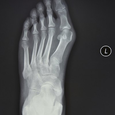 Left foot X-ray