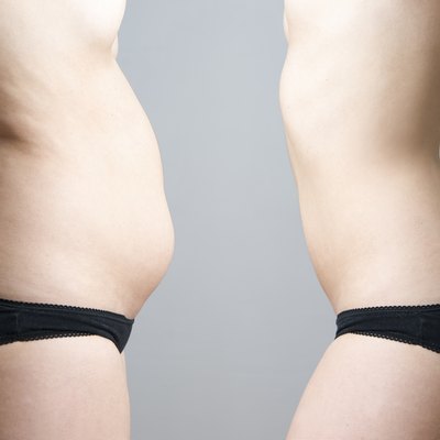 Obesity before after