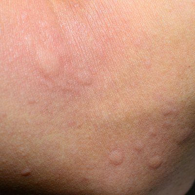 ill allergic rash dermatitis eczema skin texture.