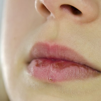 virus herpes