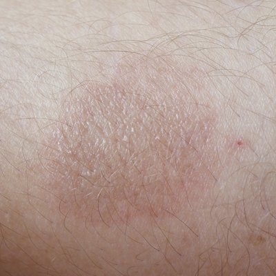burn on skin