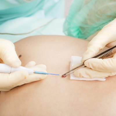 Mole Removal