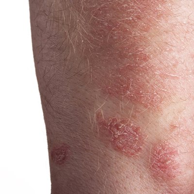 Psoriasis on the arm