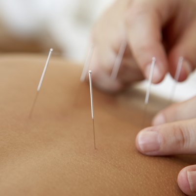 Therapist performing acupuncture