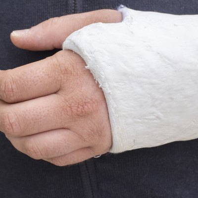 Man with his broken arm. Arm in cast.