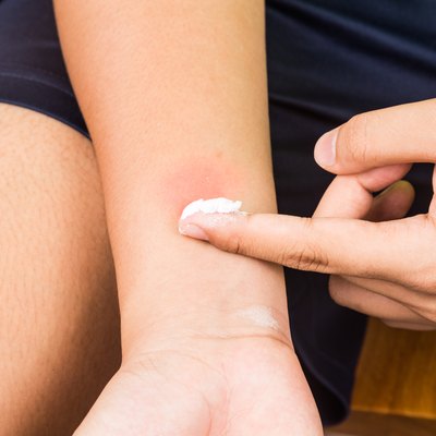 Baking soda being used to relieve itching from insect bites.