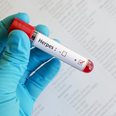 Herpes positive