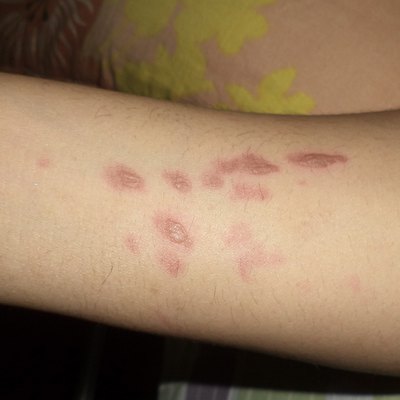Burn marks